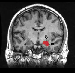 MRI coronal view of a hippocampus shown in red.