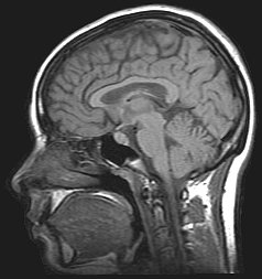 لتشخيص فَرْطُ الضَّغْطِ داخِلَ القِحْف مَجْهُوْلُ السَّبَب، يجب إجراء تصوير عصبي (مثل تصوير بالرنين المغناطيسي)، للتأكيد بعدم وجود سبب أخر يؤدي إلى ارتفاع الضغط.