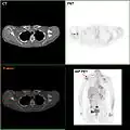 F-18 FDG PET / CT: A انبثاث سرطان الثدي للوح الكتف الأيمن