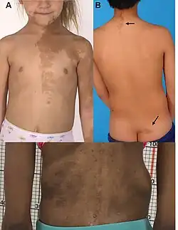 بقع القهوة بالحليب.A) تظهر كبقع بنية في جانب واحد من الجسم على وجه وصدر وذراع بنت مصابة بالمتلازمة ويبلغ عمرها 5 سنين. توزيع البقع يتبع تطور خطوط بلاشكو.B) تظهر خلف الرقبة وعلى الأرداف.