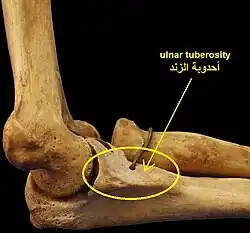 كسر الزند