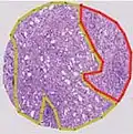 Gleason pattern 9 (4+5).jpg