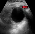 Mild gallbladder wall thickening of 3.5&nbsp;mm in a person with acute cholecystitis as seen on ultrasound