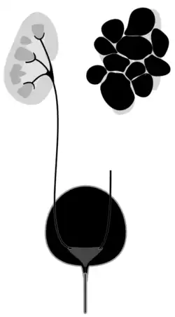 Diagram of multicystic dysplastic kidney