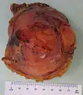 ورم شحمي نقوي في الغدة الكظرية