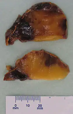 قطاع في الورم يوضح تنوع لونه من الأصفر للأحمر للبني تبعًا لتوزيع الدم والشحم والخلايا المكونة للدم.