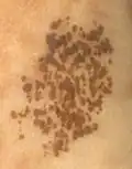 وحمة مرقطة