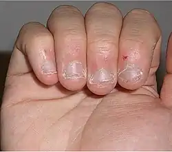 Multiple, dystrophic, irregular, shortened fingernails
