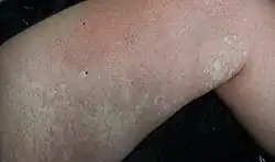 وحمة فقيرة الدم