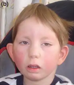 Boy with Okamoto syndrome, showing the characteristic facial features