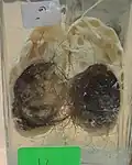 ورم مسخي للمبيض