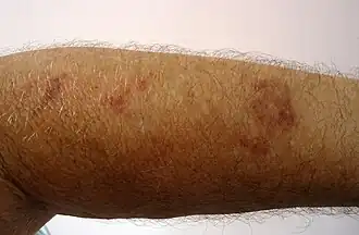 البوربورة الشيخوخي