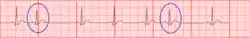 Two PACs as seen on a rhythm strip