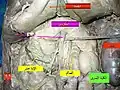 البنكرياس.
