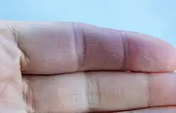 ورم دموي متقطع في اليد في متلازمة آتشينباخ؛ يظهر غالبًا على السطح الداخلي للإصبع وتحت الإصبع الأوسط أو السبابة عند المفاصل للعظمة الفالانك الأول أو الثاني الفالانك.