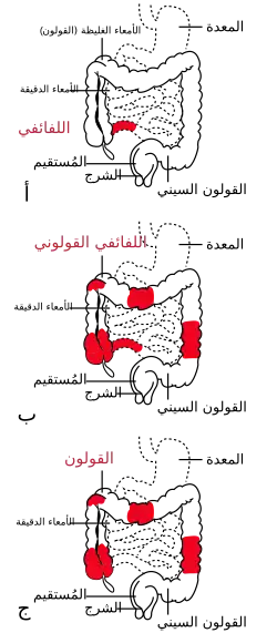 المواقع الثلاث الأكثر تعرضا للإصابة بداء كرون