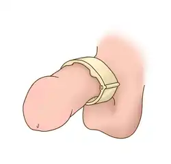 ملقاط القضيب
