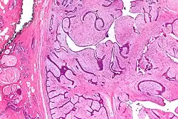 صورة مجهرية of a phyllodes tumor (right of image) with the characteristic long clefts and myxoid cellular stroma. Normal breast and مرض الثدي الكيسي الليفي are also seen (left of image). صبغة الهيماتوكسيلين واليوزين.