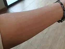 شرى جسمي، وبشكل أكثر تحديدًا كتوبية الجلد