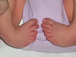 اعوجاج القدم ثنائي الجانب