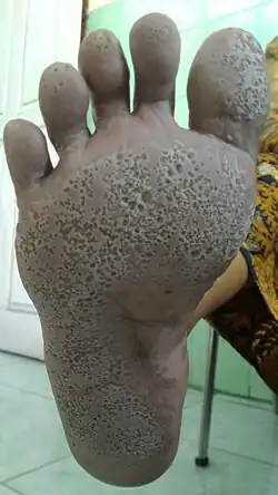 Right foot affected with pitted keratolysis