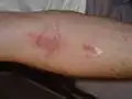 طفح بعد يومين من التعرض لشجرة الطلاء الصيني.