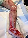 تنضير و زراعة جلد بعد عملية البتر).