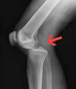 Plain lateral X-ray of the left knee showing a posterior knee dislocation.mw-parser-output cite.citation{font-style:inherit;word-wrap:break-word}.mw-parser-output .citation q{quotes:"\"""\"""'""'"}.mw-parser-output .citation:target{background-color:rgba(0,127,255,0.133)}.mw-parser-output .id-lock-free.id-lock-free a{background:url("//upload.wikimedia.org/wikipedia/commons/6/65/Lock-green.svg")right 0.1em center/9px no-repeat}.mw-parser-output .id-lock-limited.id-lock-limited a,.mw-parser-output .id-lock-registration.id-lock-registration a{background:url("//upload.wikimedia.org/wikipedia/commons/d/d6/Lock-gray-alt-2.svg")right 0.1em center/9px no-repeat}.mw-parser-output .id-lock-subscription.id-lock-subscription a{background:url("//upload.wikimedia.org/wikipedia/commons/a/aa/Lock-red-alt-2.svg")right 0.1em center/9px no-repeat}.mw-parser-output .cs1-ws-icon a{background:url("//upload.wikimedia.org/wikipedia/commons/4/4c/Wikisource-logo.svg")left 0.1em center/12px no-repeat}body:not(.skin-timeless):not(.skin-minerva) .mw-parser-output .id-lock-free a,body:not(.skin-timeless):not(.skin-minerva) .mw-parser-output .id-lock-limited a,body:not(.skin-timeless):not(.skin-minerva) .mw-parser-output .id-lock-registration a,body:not(.skin-timeless):not(.skin-minerva) .mw-parser-output .id-lock-subscription a,body:not(.skin-timeless):not(.skin-minerva) .mw-parser-output .cs1-ws-icon a{background-size:contain;padding:0 1em 0 0}.mw-parser-output .cs1-code{color:inherit;background:inherit;border:none;padding:inherit}.mw-parser-output .cs1-hidden-error{display:none;color:var(--color-error,#d33)}.mw-parser-output .cs1-visible-error{color:var(--color-error,#d33)}.mw-parser-output .cs1-maint{display:none;color:#085;margin-left:0.3em}.mw-parser-output .cs1-kern-left{padding-left:0.2em}.mw-parser-output .cs1-kern-right{padding-right:0.2em}.mw-parser-output .citation .mw-selflink{font-weight:inherit}@media screen{.mw-parser-output .cs1-format{font-size:95%}html.skin-theme-clientpref-night .mw-parser-output .cs1-maint{color:#18911f}}@media screen and (prefers-color-scheme:dark){html.skin-theme-clientpref-os .mw-parser-output .cs1-maint{color:#18911f}}Duprey، K؛ Lin، M (فبراير 2010). "Posterior knee dislocation". The western journal of emergency medicine. ج. 11 ع. 1: 103–4. PMID:20411095.