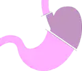 الاستئصال المعدي الأدنى