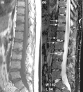 (a) T1-weighted and (b) short tau inversion recovery (STIR) magnetic resonance images of منطقة قطنية and lower صدر الإنسان spine in psoriatic arthritis. Signs of active inflammation are seen at several levels (arrows). In particular, قائمة مصطلحات تشريح المواضع (طب) spondylitis is seen at level L1/L2 and an inflammatory Andersson lesion at the upper vertebral endplate of L3.