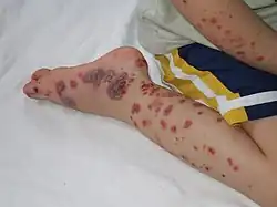 حالة شديدة من فرفرية هينوخ-شونلاين على قدم طفل وساقه وذراعه