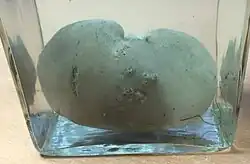 خراج ناجم عن تقيح الدم في الكلى