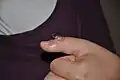 ورم جبيبي على الإبهام