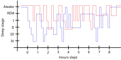 Sleep pattern of a restless legs syndrome patient (red) vs. a healthy sleep pattern (blue).