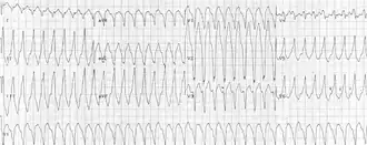 Monomorphic ventricular tachycardia