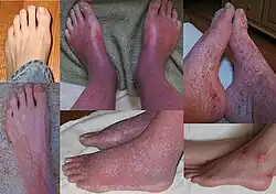 متلازمة الرجل الأحمر