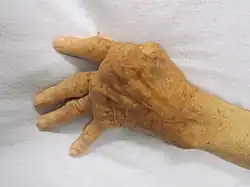 يد متضررة من التهاب المفاصل الروماتويدي