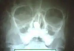 صورة بالأشعة السينية للجيوب الأنفية، تٌظهر الحصاة الأنفية.