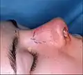 الصورة أ. عملية تجميل الأنف المفتوحة: قبل الجراحة، تضمن الإرشادات (باللون الأرجواني) شقوق الجراح الدقيقة في قطع خطة تصحيح عيب الأنف.
