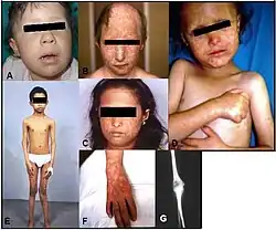 أشخاص يعانون من مظاهر مختلفة لتبكّل الجلد