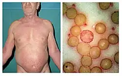 مرض سيزاري لدى رجل يبلغ عمره 61 سنة عانى في عام 1972 من حكة قاسية لمدة ستة شهور. على اليمين بظهر شريط الدم المحيطي مصبوغا بصبغة شيف-حمض البيريوديك (PAS) وتظهر الخلايا التائية الورمية (خلية سيزاري).