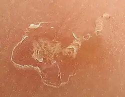 صورة مكبرة لمسار العث: الجزء الايسر يبين حك العث للدخول إلى الجلد. حفر العث على الجزء الايمن و يظهر كنقطة سوداء في نهاية المسار