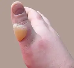 Scalded thumb, two days after a مشعاع explosion.