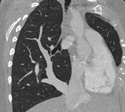 صورة مقطعية محوسبة للصدر تظهر متلازمة السيف الأحدب