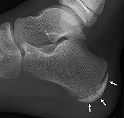 أشعة سينية of the foot of an 11-year-old child,showing sclerosis and fragmentation of the calcaneal apophysis. This is a sign of low حساسية ونوعية of Sever's disease, because those with Sever's disease may not have it, and it is commonly present in feet without any symptoms..mw-parser-output cite.citation{font-style:inherit;word-wrap:break-word}.mw-parser-output .citation q{quotes:"\"""\"""'""'"}.mw-parser-output .citation:target{background-color:rgba(0,127,255,0.133)}.mw-parser-output .id-lock-free.id-lock-free a{background:url("//upload.wikimedia.org/wikipedia/commons/6/65/Lock-green.svg")right 0.1em center/9px no-repeat}.mw-parser-output .id-lock-limited.id-lock-limited a,.mw-parser-output .id-lock-registration.id-lock-registration a{background:url("//upload.wikimedia.org/wikipedia/commons/d/d6/Lock-gray-alt-2.svg")right 0.1em center/9px no-repeat}.mw-parser-output .id-lock-subscription.id-lock-subscription a{background:url("//upload.wikimedia.org/wikipedia/commons/a/aa/Lock-red-alt-2.svg")right 0.1em center/9px no-repeat}.mw-parser-output .cs1-ws-icon a{background:url("//upload.wikimedia.org/wikipedia/commons/4/4c/Wikisource-logo.svg")left 0.1em center/12px no-repeat}body:not(.skin-timeless):not(.skin-minerva) .mw-parser-output .id-lock-free a,body:not(.skin-timeless):not(.skin-minerva) .mw-parser-output .id-lock-limited a,body:not(.skin-timeless):not(.skin-minerva) .mw-parser-output .id-lock-registration a,body:not(.skin-timeless):not(.skin-minerva) .mw-parser-output .id-lock-subscription a,body:not(.skin-timeless):not(.skin-minerva) .mw-parser-output .cs1-ws-icon a{background-size:contain;padding:0 1em 0 0}.mw-parser-output .cs1-code{color:inherit;background:inherit;border:none;padding:inherit}.mw-parser-output .cs1-hidden-error{display:none;color:var(--color-error,#d33)}.mw-parser-output .cs1-visible-error{color:var(--color-error,#d33)}.mw-parser-output .cs1-maint{display:none;color:#085;margin-left:0.3em}.mw-parser-output .cs1-kern-left{padding-left:0.2em}.mw-parser-output .cs1-kern-right{padding-right:0.2em}.mw-parser-output .citation .mw-selflink{font-weight:inherit}@media screen{.mw-parser-output .cs1-format{font-size:95%}html.skin-theme-clientpref-night .mw-parser-output .cs1-maint{color:#18911f}}@media screen and (prefers-color-scheme:dark){html.skin-theme-clientpref-os .mw-parser-output .cs1-maint{color:#18911f}}Mark A Noffsinger (7 سبتمبر 2016). "Calcaneal Apophysitis (Sever Disease) Workup". مدسكيب. مؤرشف من الأصل في 2020-02-06. اطلع عليه بتاريخ 2017-01-19.