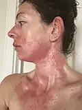 حدوث تفاعل تحسس شديد بعد 4 أيام من التعرض للبلوط السام.