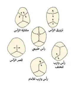 تزورق الرأس مقارنةً بالأشكال الأخرى من تشوهات الجمجمة