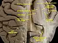 بطينات الدماغ والعقد القاعدية.مشهد من الأعلى قطع أفقي .تشريح عميق