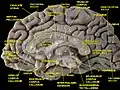 السطح الإنسي لنصف الكرة المخي.منظر إنسي. تشريح عميق.