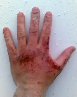 حرق كيميائي بسبب التعرض لهيدروكسيد الصوديوم بعد 44 ساعة.